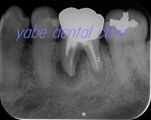 パーフォレーション