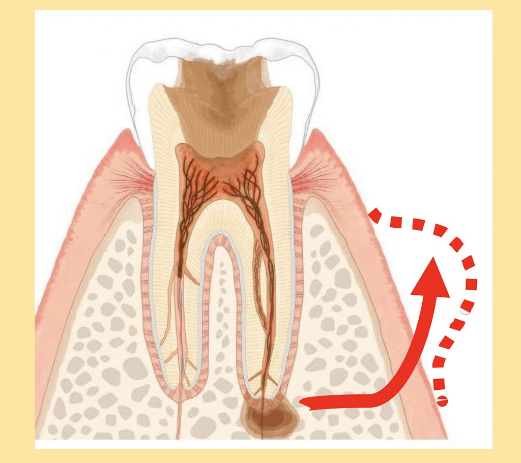 歯ぐきが腫れる