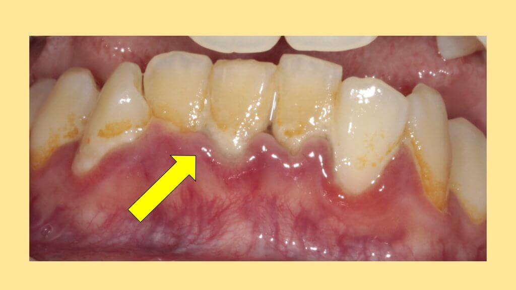 歯ぐきが腫れる理由