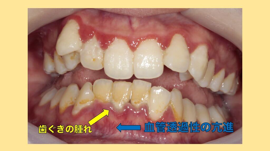 歯ぐきが腫れる