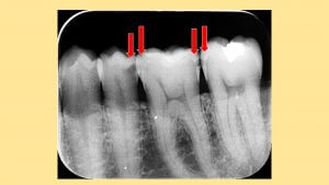 歯と歯の間の虫歯
