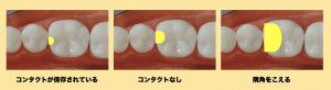 歯と歯の間の虫歯