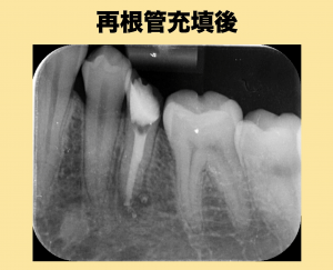 再根管充填後