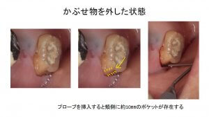 歯根破折による歯性上顎洞炎