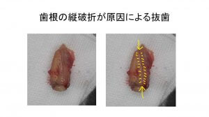 歯根破折による歯性上顎洞炎