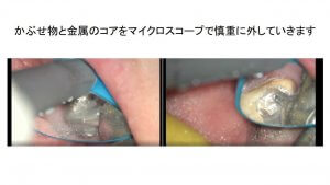 歯根破折による歯性上顎洞炎